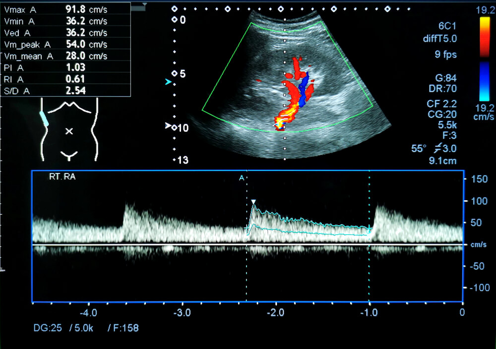 Kolor dopler ultrazvuk renalnih arterija