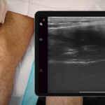 ultrazvuk kolena, pregled kolena ultrazvukom, ultrazvuk kolena Beograd, ultrazvuk zglobova kolena, ultrazvucni pregled ligamenata zglobova, dijagnostika kolena ultrazvukom - Dr Nestorov 1