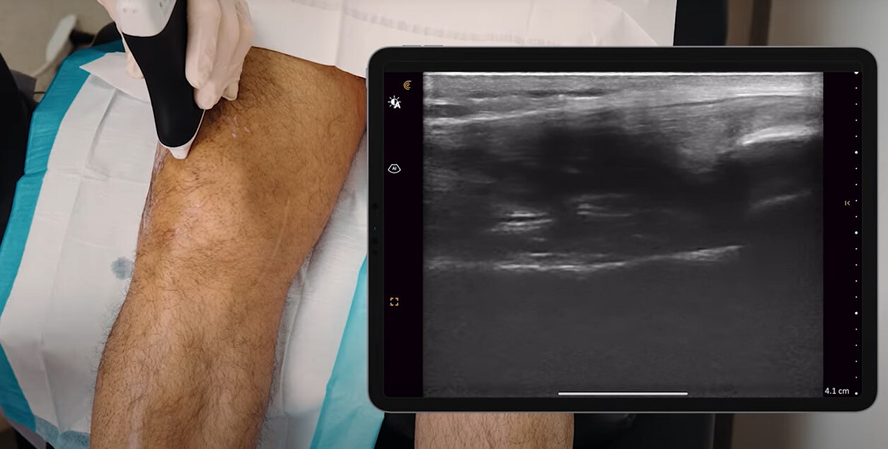 ultrazvuk kolena, pregled kolena ultrazvukom, ultrazvuk kolena Beograd, ultrazvuk zglobova kolena, ultrazvucni pregled ligamenata zglobova, dijagnostika kolena ultrazvukom - Dr Nestorov 1