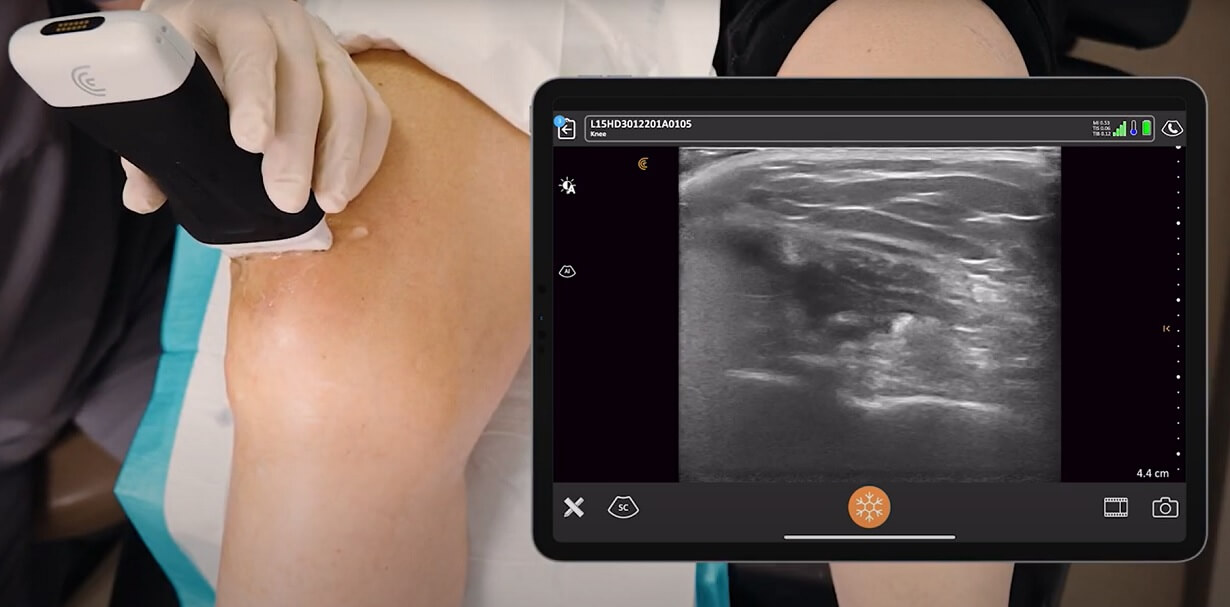 ultrazvuk kolena, pregled kolena ultrazvukom, ultrazvuk kolena Beograd, ultrazvuk zglobova kolena, ultrazvucni pregled ligamenata zglobova, dijagnostika kolena ultrazvukom - Dr Nestorov 4
