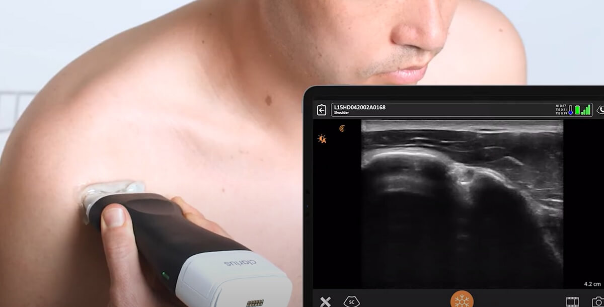 ultrazvuk misica i tetiva, muskuloskeletni ultrazvuk - Dr Nestorov 3
