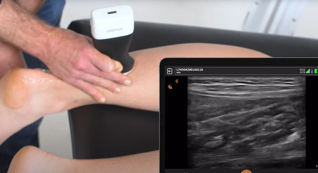 ultrazvuk misica i tetiva, muskuloskeletni ultrazvuk - Dr Nestorov 4