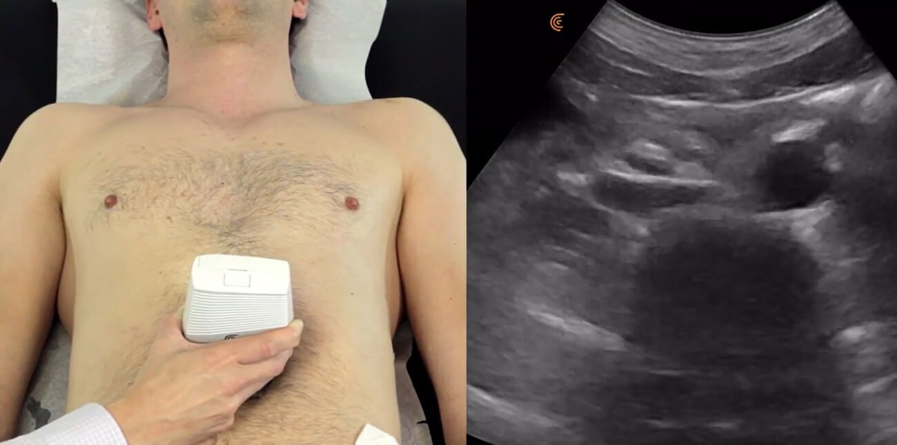 ultrazvuk trbusne aorte, ultrazvuk abdominalne aorte, skrining trbusne aorte, dopler trbusne aorote, dopler abdominalne aorte - Dr Nestorov 1