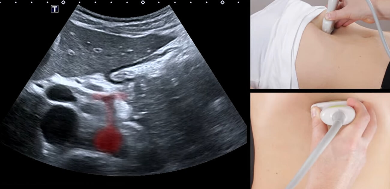 ultrazvuk trbusne aorte, ultrazvuk abdominalne aorte, skrining trbusne aorte, dopler trbusne aorote, dopler abdominalne aorte - Dr Nestorov 2